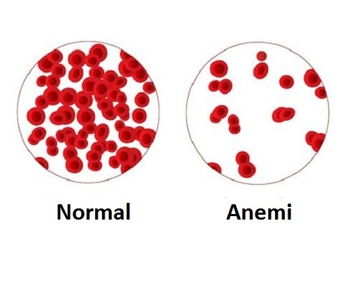 Anemi Hastalığı Oluşumu Ve Nedenleri